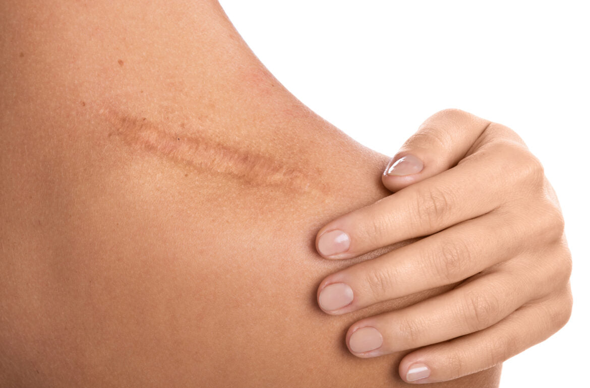 How to Reduce the Appearance of Your Scar