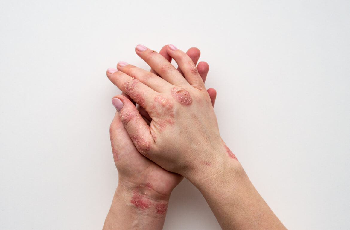 9 Frequently Asked Questions About Psoriasis