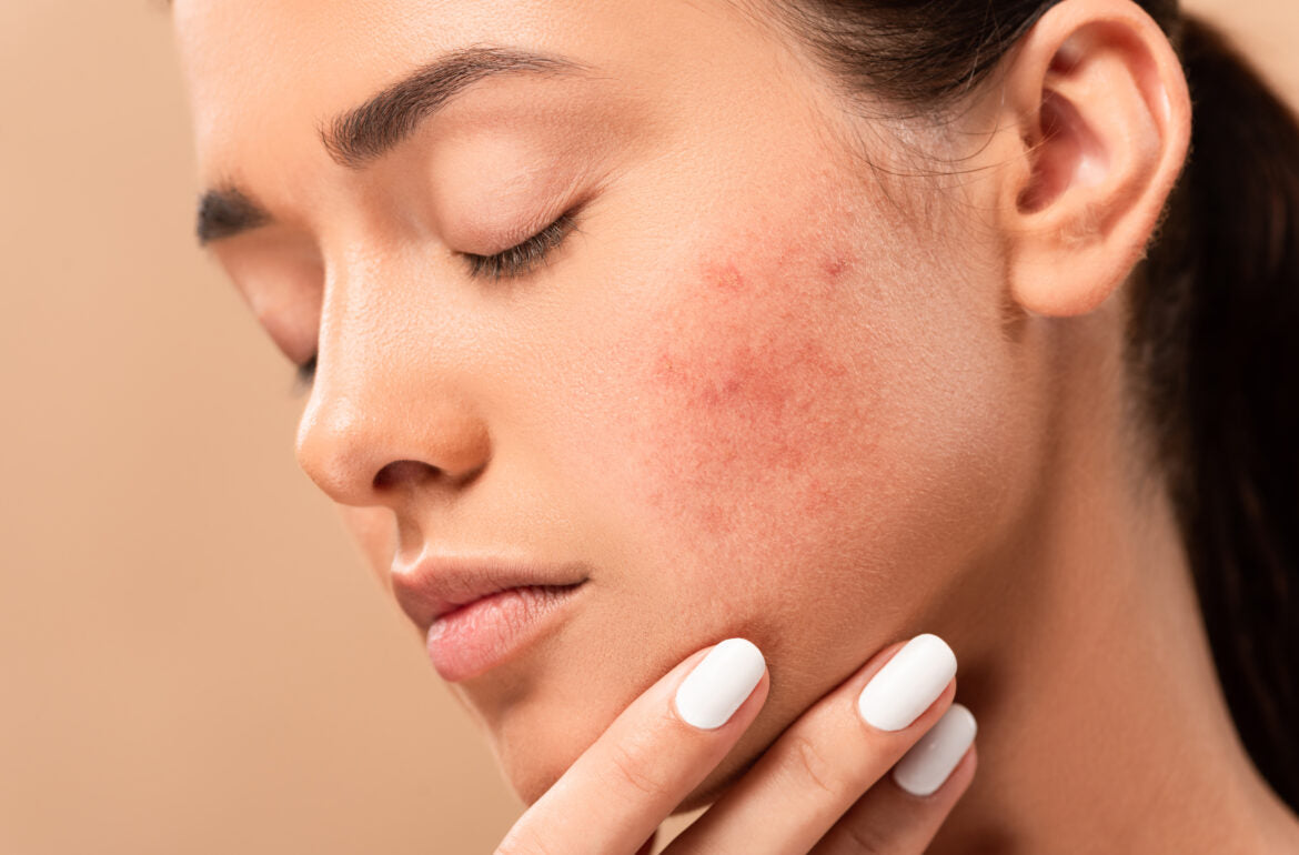 How To Handle Sensitive, Acne-Prone Skin