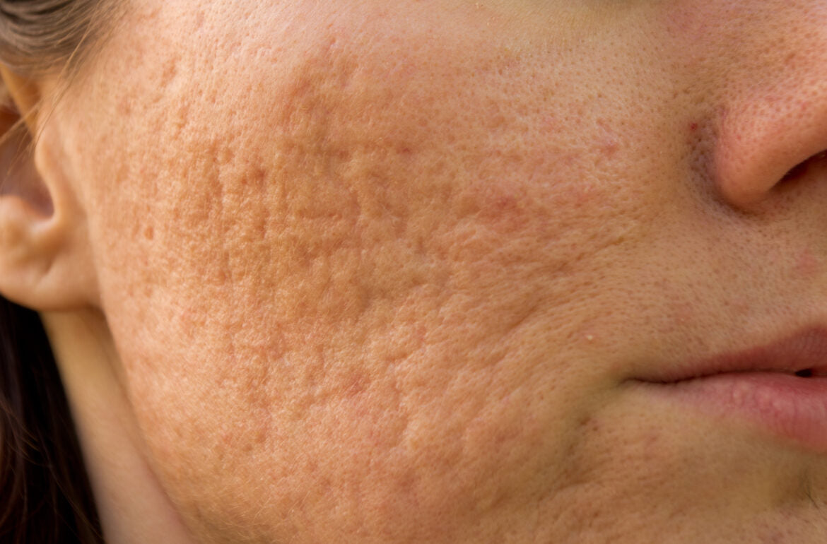 Common Questions About Acne Scarring