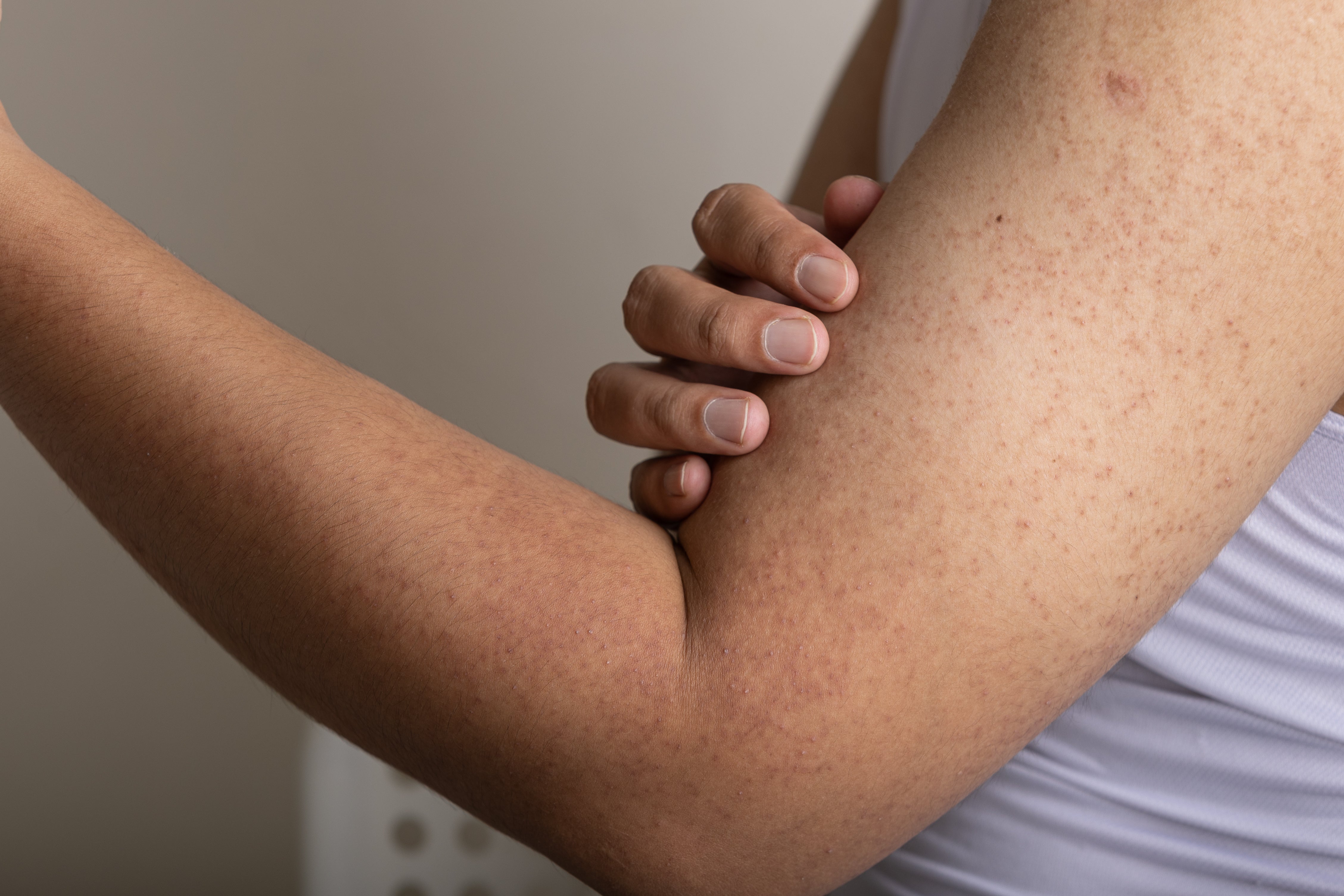 KERATOSIS PILARIS: HOW TO TREAT AND SMOOTH BUMPY SKIN