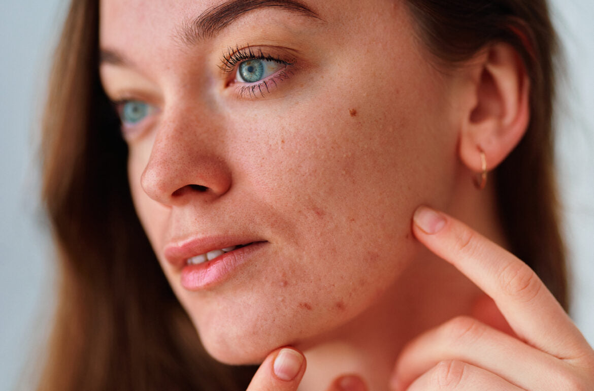 Treating Adult Acne