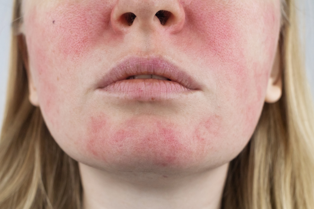 ROSACEA 101: IDENTIFYING & MANAGING THIS COMMON SKIN CONDITION