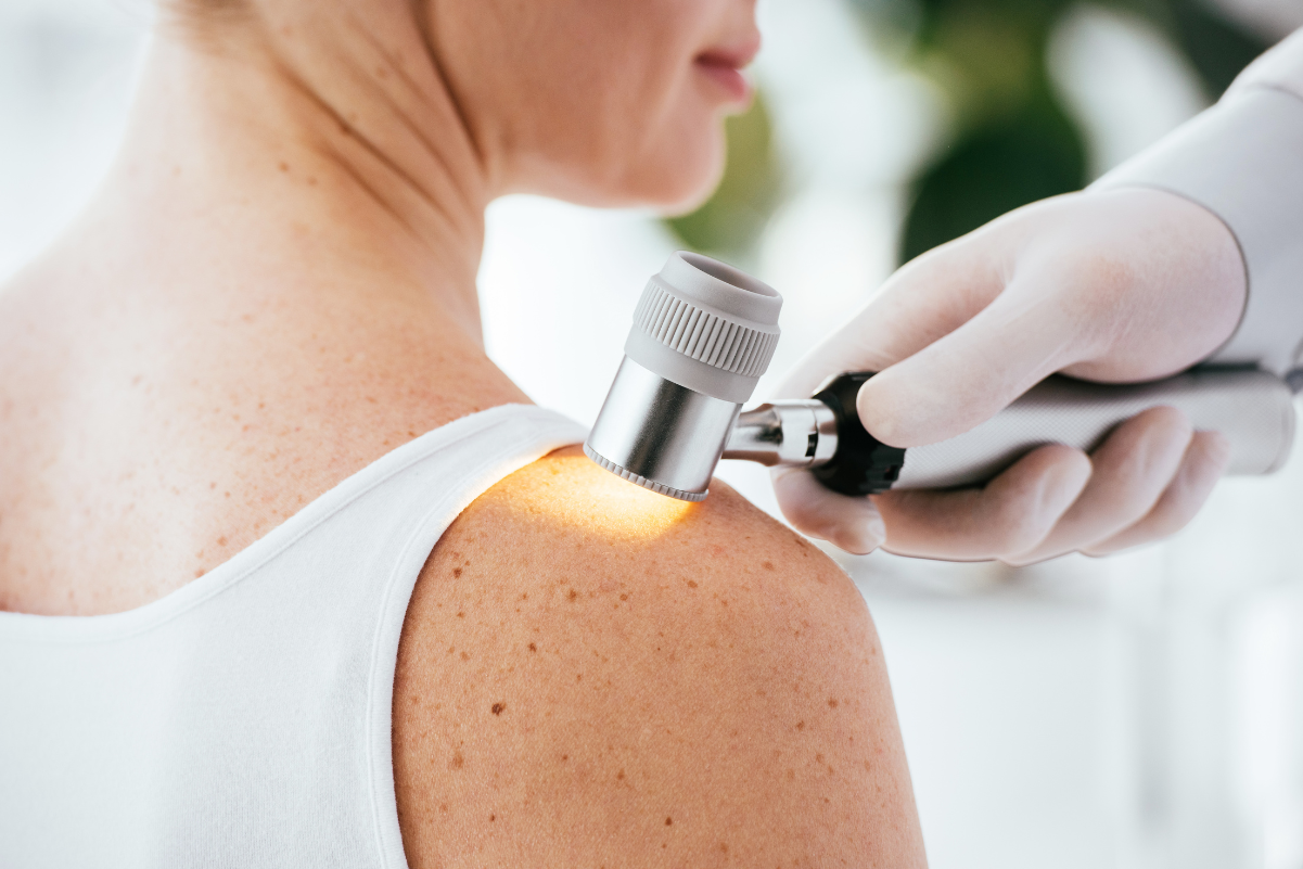 SKIN CANCER AWARENESS - A FOCUS ON MELANOMA