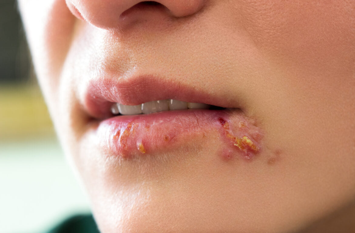Herpes: What You Need To Know – North Metro Dermatology