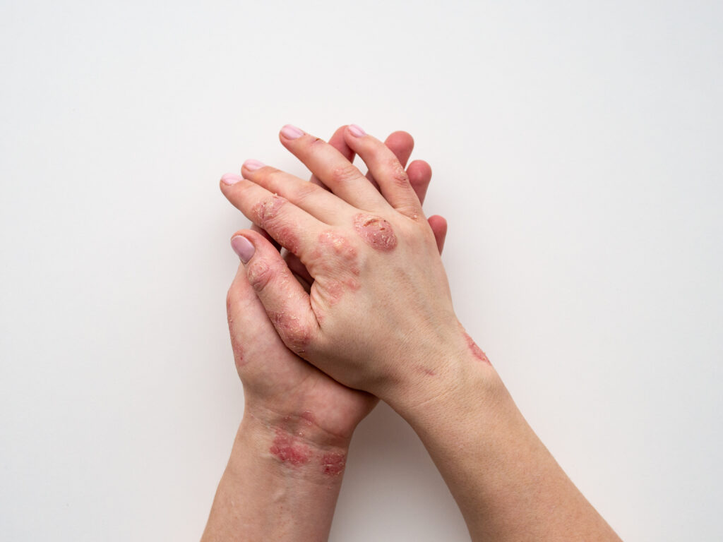 9 FREQUENTLY ASKED QUESTIONS ABOUT PSORIASIS