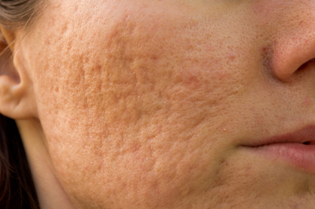 COMMON QUESTIONS ABOUT ACNE SCARRING